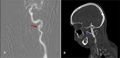 Hypoglossal Nerve Palsy Due To Internal Carotid Artery Dissection With Pseudoaneurysm Formation