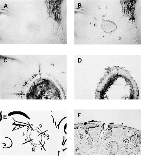 Figure 2 From Mohs Micrographic Surgery For Melanoma A Case Series A