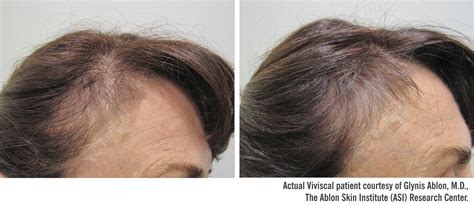 The medical term for hair loss is alopecia. #Beforeafter #clinical #trial results: Day 0 Day 90 with # ...
