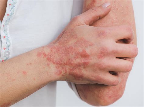 Come Si Cura La Dermatite Batterica
