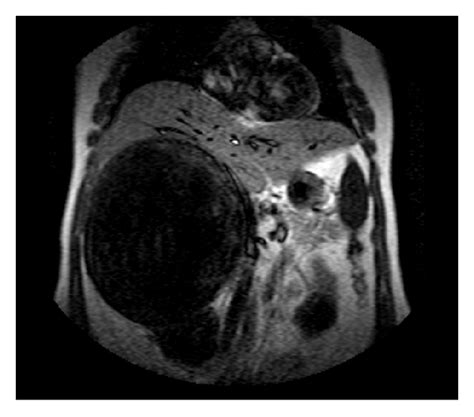 Idiopathic Unilateral Adrenal Haemorrhage And Adrenal Mass A Case