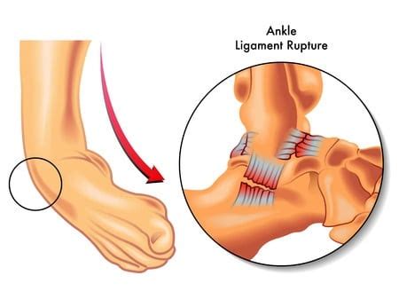 I'll know more about recovery time when i get to ku. What Is a Sprain? : Terminology Tuesday - Howard J. Luks, MD