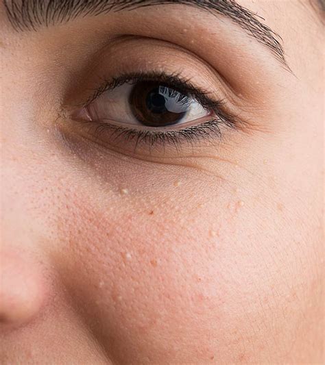 How To Get Rid Of Milia White Bumps On Face Skin Bumps Pimples On Face