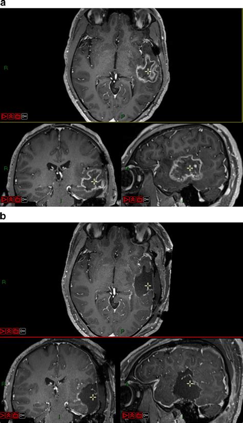 Mri Of The Illustrative Case T1 With Gadolinium Sequence A