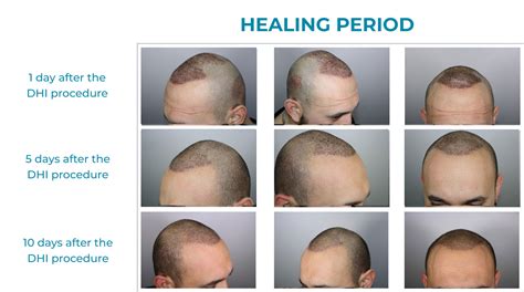 Hair Transplant Step by Step Direct Hair Implant DHI Panamá