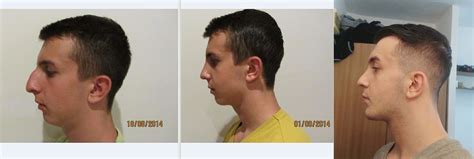 Incels come in all shapes and sizes. I got a rhinoplasty + chin implant - here are the results