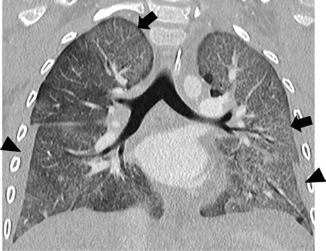 Pneumocystis Jiroveci Pneumonia In A 6 Year Old Male With Acute