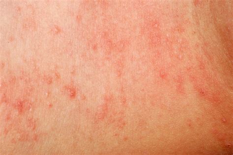 Dermatitis Herpetiformis An Itchy Burning Blistering Rash