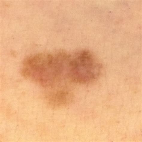 Early Stage Melanoma Symptoms Doctor Heck