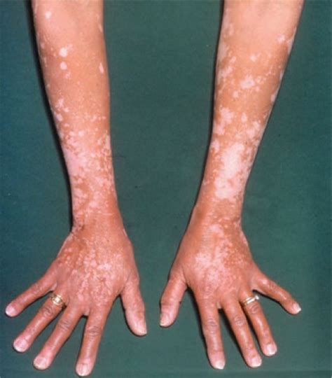 Vitiligo What General Physicians Need To Know Rcp Journals