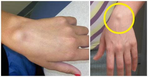 This Is Why Some People Have That Lump On Their Wrist 10 Gone Viral