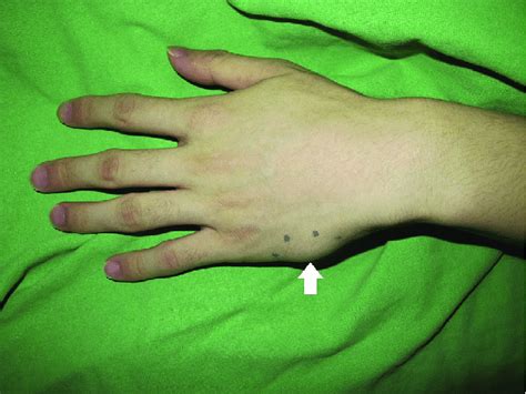 Case 2 A Progressive Protruding Mass Lesion On The Ulnar Side Of The