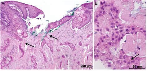 Calcifying Epithelial Odontogenic Tumor Histology