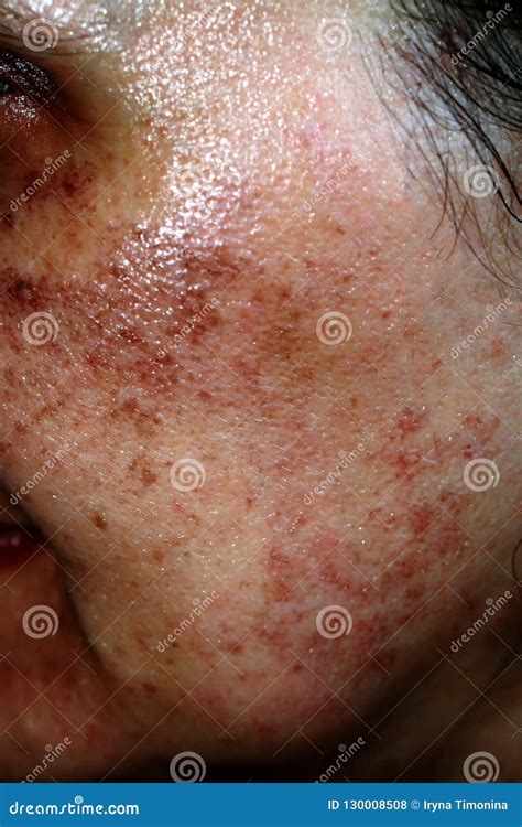 Pigmented Spots On The Face Pigmentation On Cheeks Stock Photo Image