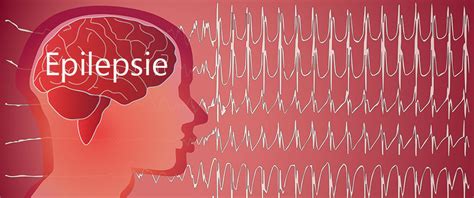 Epilepsie Ursachen Symptome Und Behandlung Liebenswert