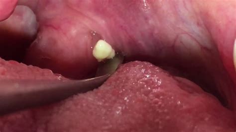Tonsil Stone Removal Youtube