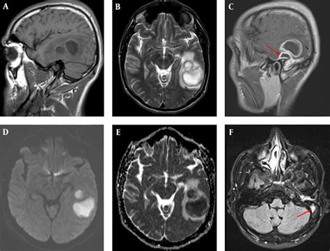 Mastoiditis Brain Abscess And Sinus Thrombosis As Complications Of