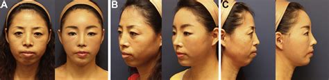 Forehead Lift For Asians Facial Plastic Surgery Clinics