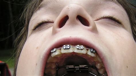 good looking people with braces