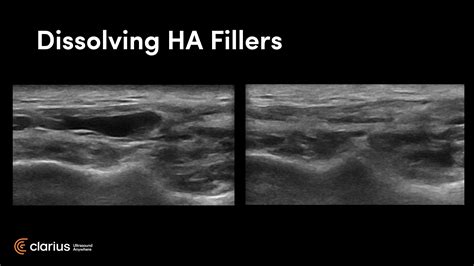 Video Learn How To Use Ultrasound To Treat Dermal Filler