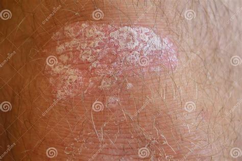 Psoriasis En La Rodilla Imagen De Archivo Imagen De Cierre 71907931