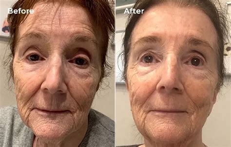 Top Laser Treatments For Wrinkles And Fine Lines Lyma