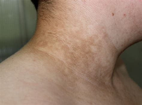 Which Treatments Will Work Best For Hyperpigmentation Pennsylvania