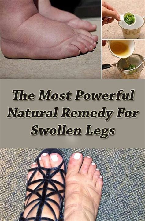 Themostpowerfulnaturalremedyforswollenlegs Swollen Legs Foot