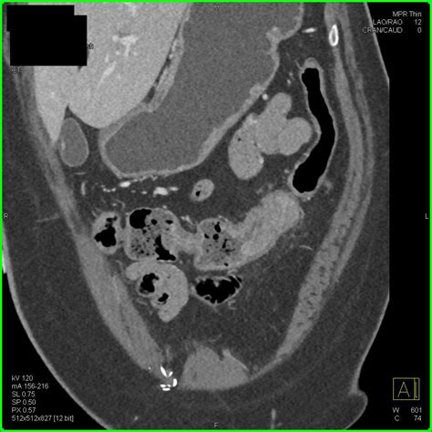 Transverse Colon Cancer In Patient With Long Standing Ulcerative