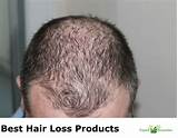 Images of Hair Loss Treatment That Really Works