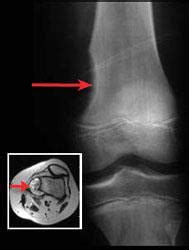 A study that looked at the differential diagnosis of foot lumps found that the toes and dorsum of the foot were the most commonly bone cancer of the foot is very rare. Bone Tumor - Types and Treatments - OrthoInfo - AAOS