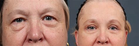 Eyelid Surgery Before After Photos Patient Louisville Ky