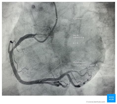 Headaches and dizziness online course: Abnormal left coronal artery: Case and images | Kenhub