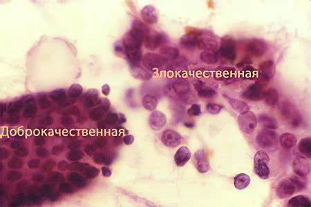 Доброкачественная опухоль – причины, стадии, виды и лечение Картинка - Доброкачественная опухоль – причины, стадии, виды и лечение