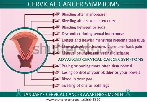 Cervical Cancer Disease Symptoms Infographic Vector Stock Vector Royalty Free