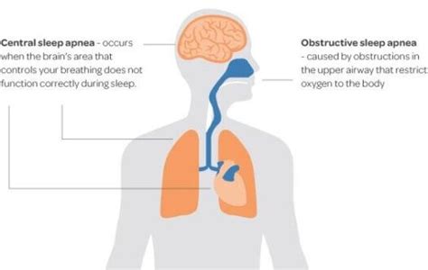 understanding the relationship between central sleep apnea and dcm dcm foundation
