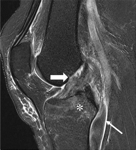 Mri T2 Mapping Of The Knee Providing Synthetic Morphologic Images