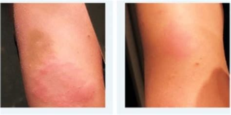 Moderna's Covid-19 jab can cause skin reactions 11 DAYS ...