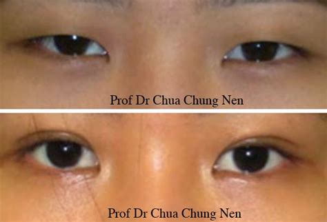 Eyelid Surgery By Prof Dr Cn Chua 蔡鐘能 July 2014