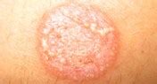 Tinea versicolor is a fungal infection that causes small patches of discolored spots on your skin. Tinea Versicolor: Causes, Symptoms, & Treatment