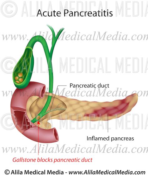 Acute Pancreatitis Caused By Gallstone Alila Medical Images