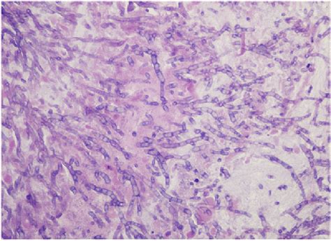 Aspergillus fumigatus is a filamentous fungi that uses both sexual and asexual means of. Microscopic view of biopsy shows strains of Aspergillus ...