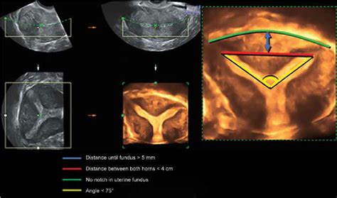 Sub Septate Uterus Colored Lines Depict The Diagnostic Criteria