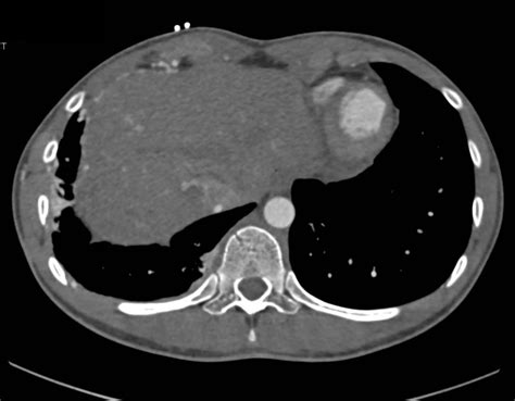 Vascular Malformation In The Chest Wall Chest Case Studies Ctisus