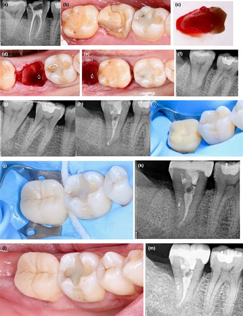 Present Status And Future Directions Surgical Extrusion Intentional