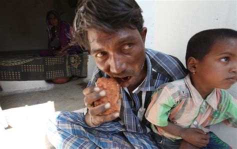 This 30 Year Old Man From Karnataka Only Eats Mud Rocks And Bricks
