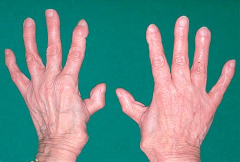 Rheumatische Hand Ursachen Diagnose Therapien Orthinform