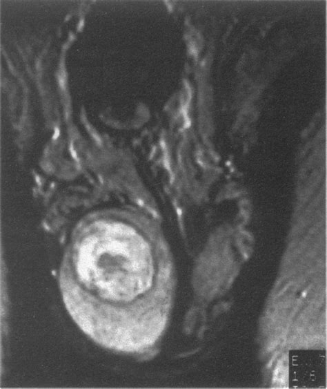 Mri Of Testis Shows Epidermoid Cyst With The Characteristic