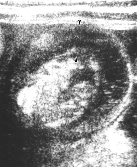 Sonographic Detection Of Lymph Nodes In The Intussusception Of Infants