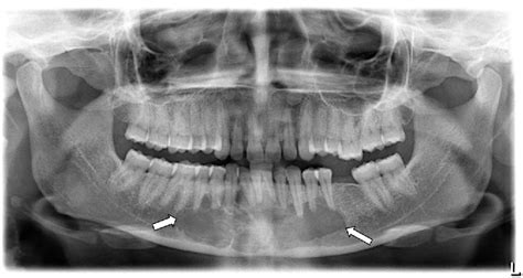 Figure 2 From An Extensive Swelling In The Anterior Mandible A Case